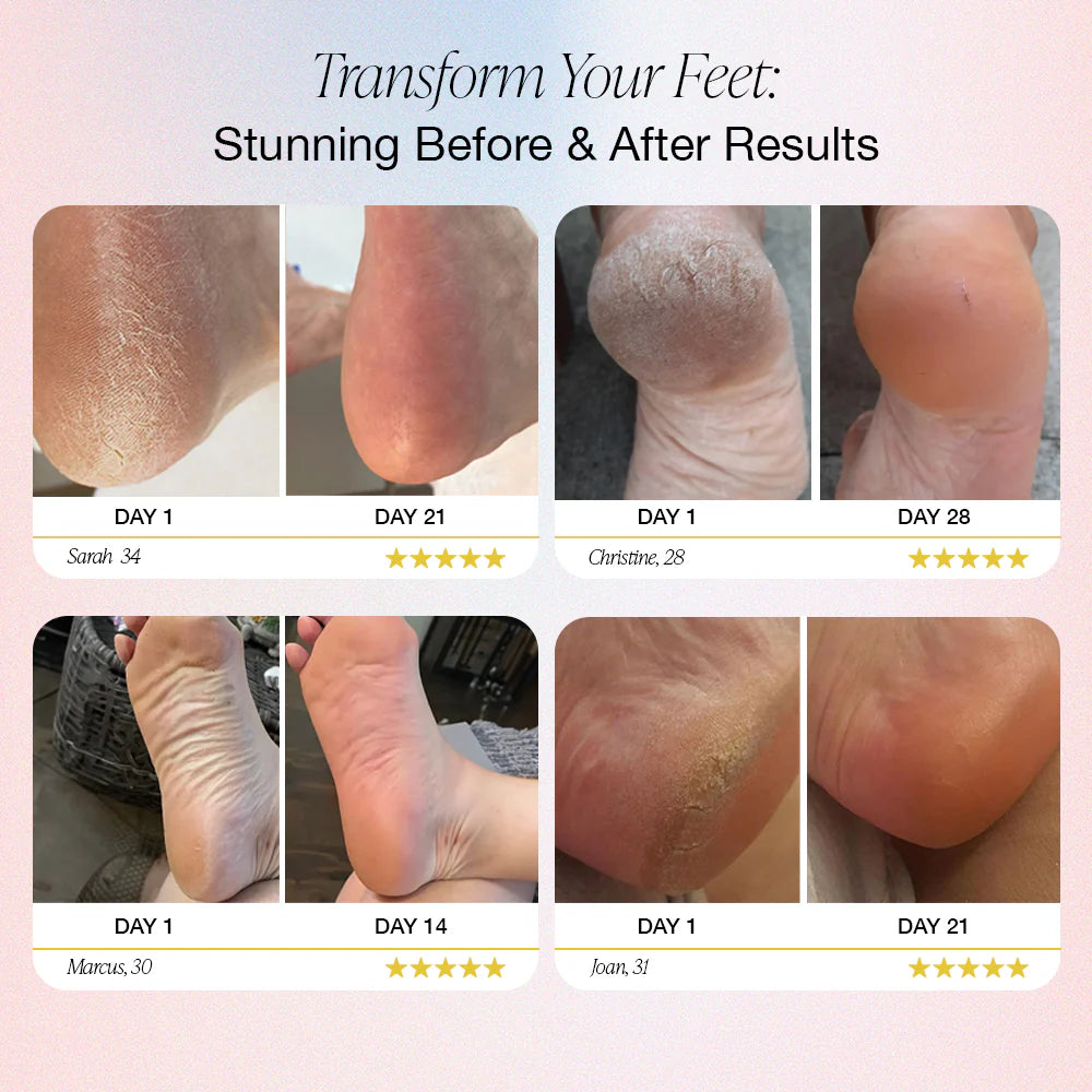 SoftSkin™ Electric Foot Callus Remover