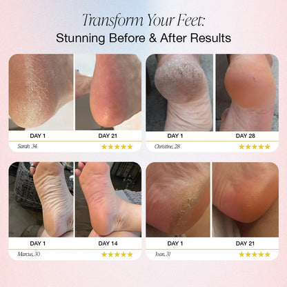 SoftSkin™ Electric Foot Callus Remover